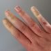 Raynauld's Phenomenon and hypnotherapy