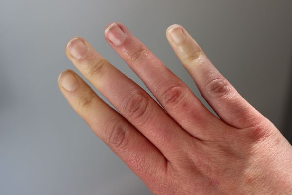Raynauld's Phenomenon and hypnotherapy